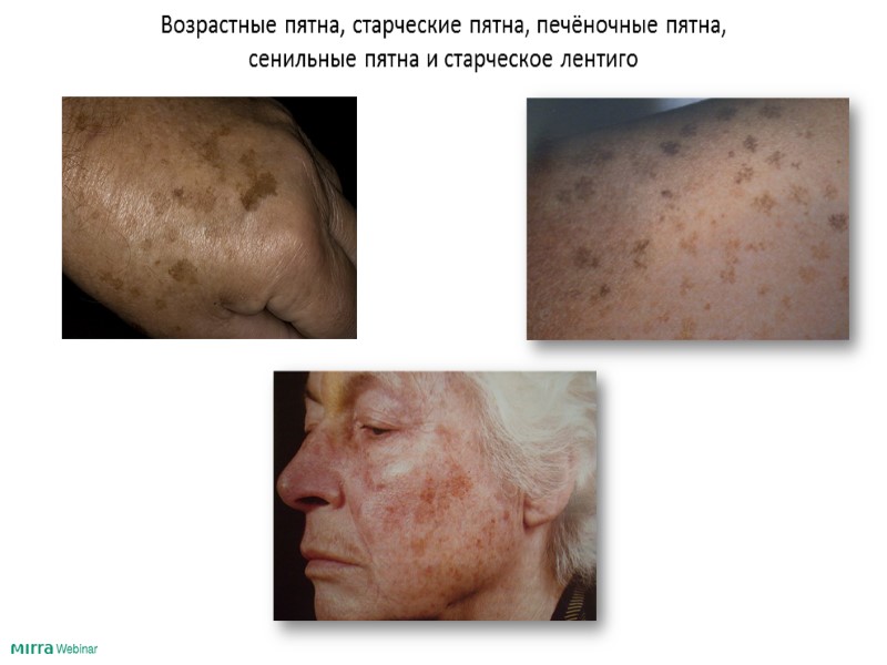 Результаты исследований  Глубина складок, форма дерматоглифа (рисунка кожи)     