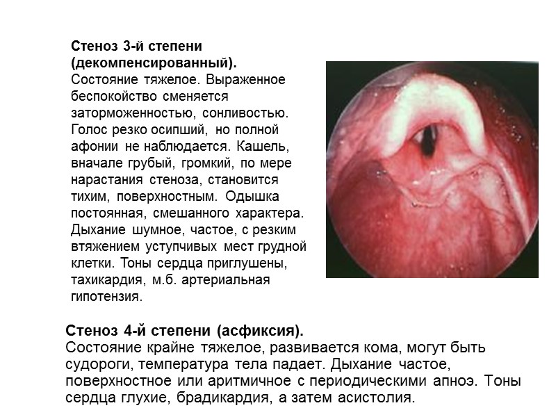 Стадии острого стенозирующего ларинготрахеита у детей    Стеноз 2-й степени (субкомпенсированный). 