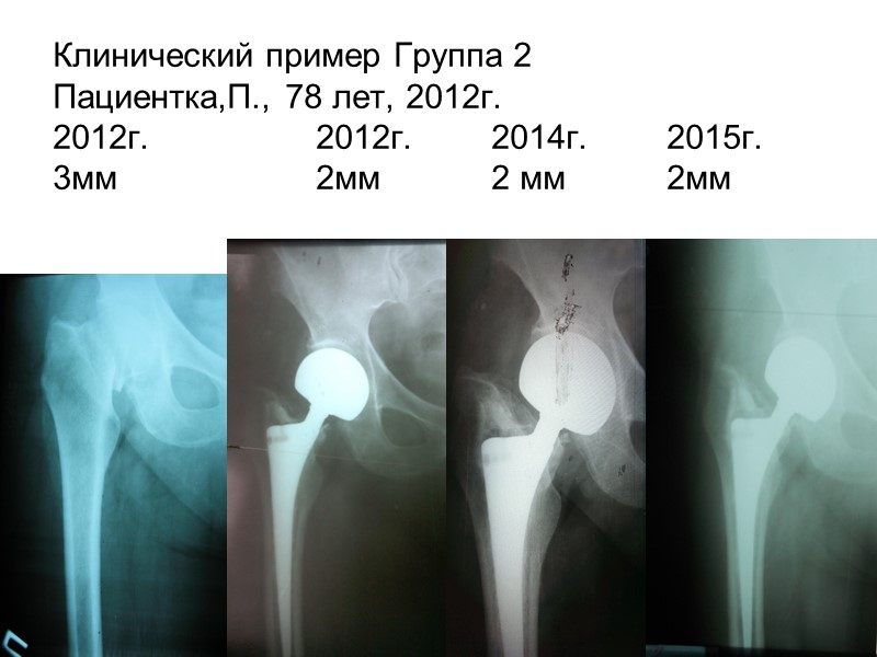 Конхоидная головка протеза  Патент № 97988, Бюл..№ 17, 10.04. 2015. .  Бесклеточная