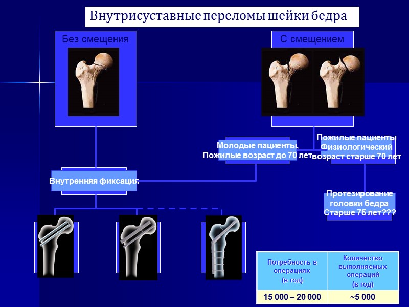 Операция при переломе шейки бедра в пожилом. Внутрисуставной перелом шейки бедра. Внутрисуставные переломы шейки бедренной кости. Переломы шейки бедра классификация.