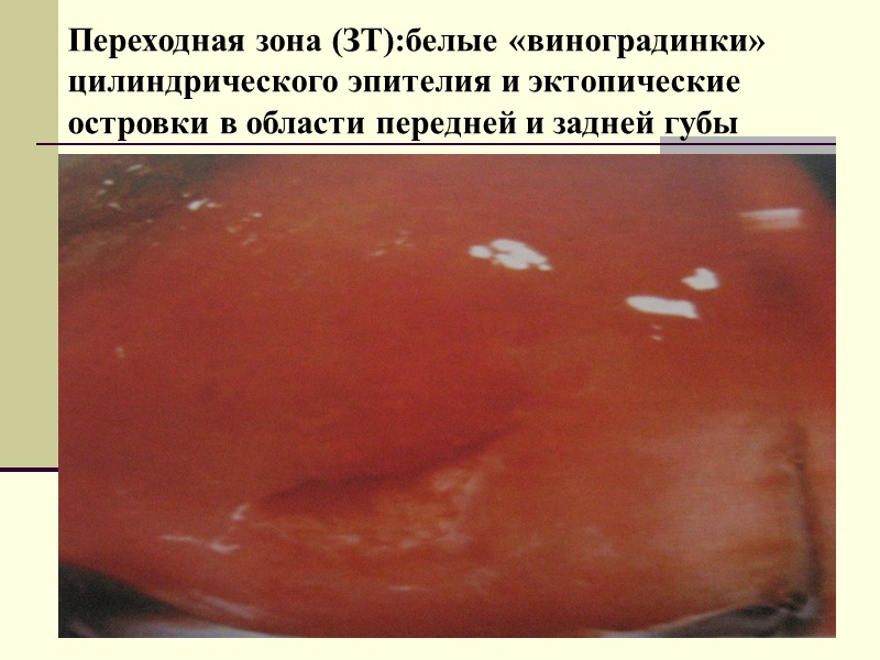 Эктопия –цилиндрический эпителий.  Большой разрыв Эммета (пациентка, 25 лет, состояние после мед.аборта до