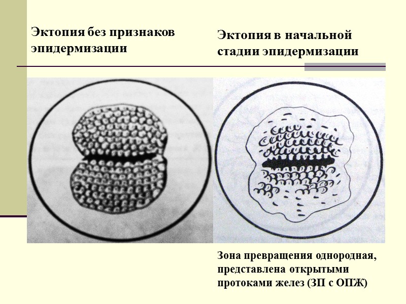 Эктопия это. Эктопия цилиндрического эпителия. Эктопия железистого эпителия.