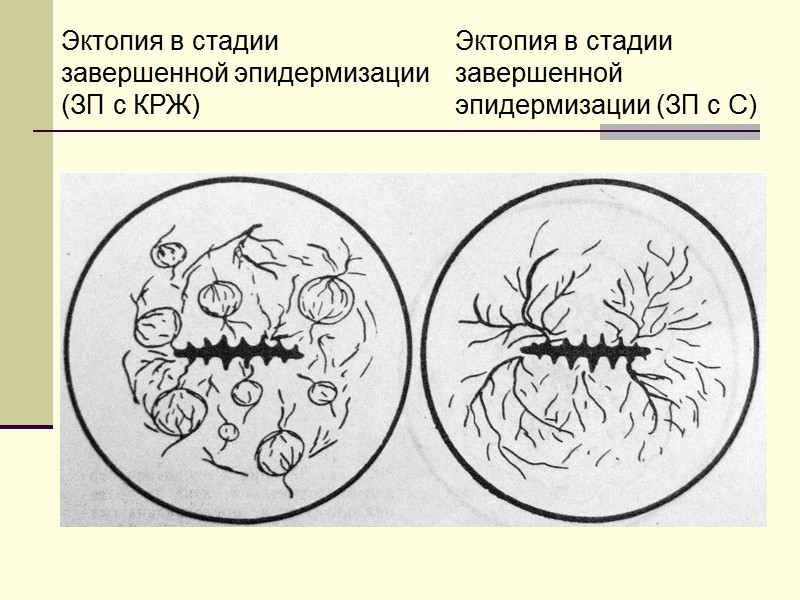 Переходная зона (зона трансформации): выпирает медная внутриматочная спираль