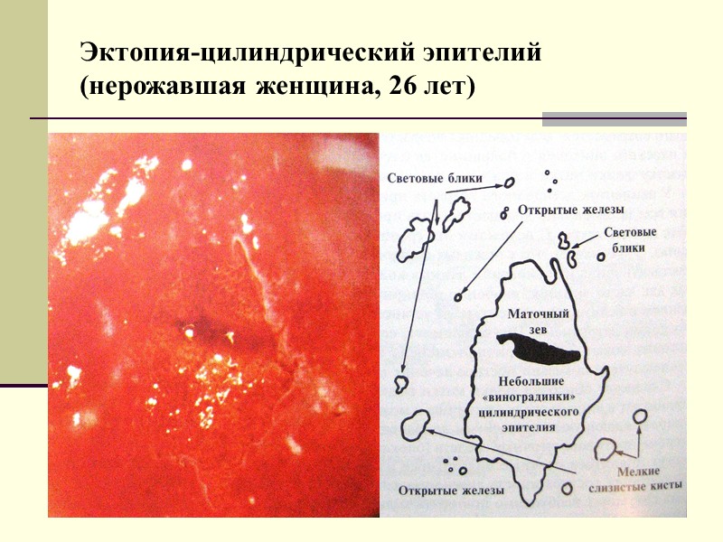 Оригинальный плоский эпителий влагалищногого отдела шейки матки (нерожавшая женщина, 33-х лет)