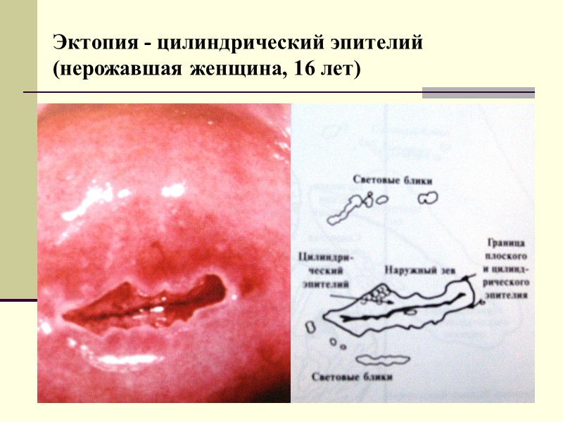 Оригинальный плоский эпителий влагалищногого отдела шейки матки (нерожавшая женщина, 33-х лет)