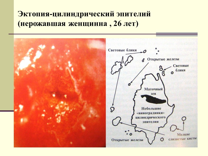 Оригинальный плоский эпителий (до раздвигания наружного зева), нерожавшая ,18 лет