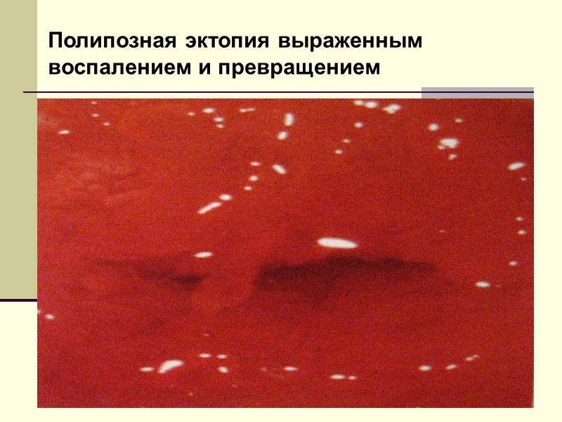 Гиперплазия слизистой цервикального канала в виде микрополиповидных разрастаний (Б.И. Железнов).  Возникновение связывают с