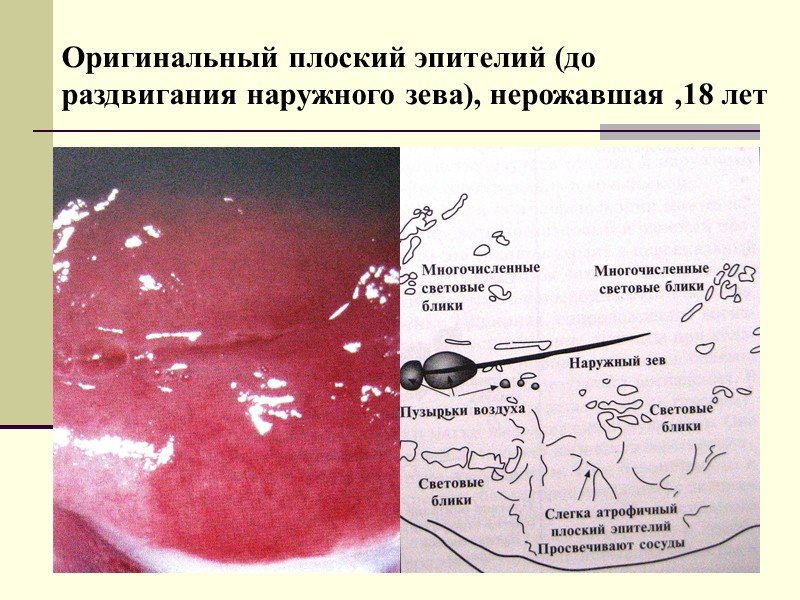 Полипозная неяркая эктопия (при приеме оральных контрацептивов, пациентка, 30 лет)