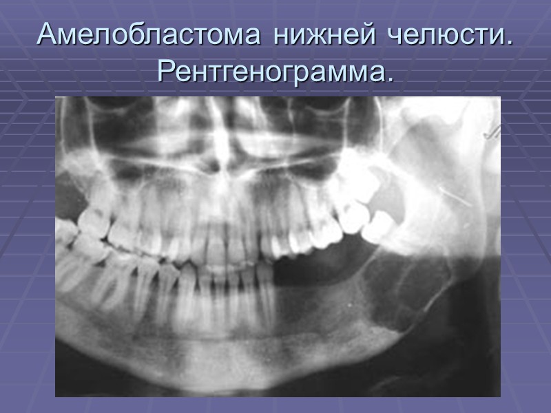 Амелобластома нижней челюсти (рентгенограмма).   На рентгенограмме заметно деструкцию тела и ветки нижней