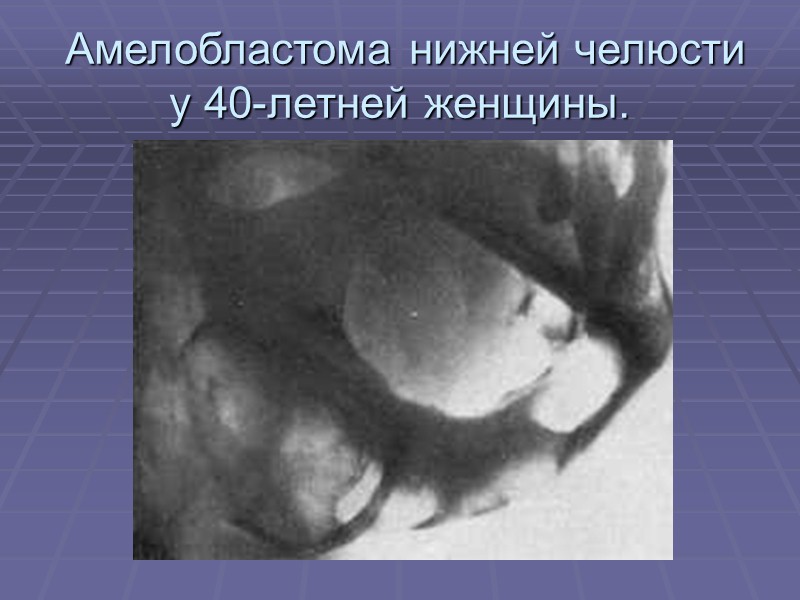 Амелобластома нижней челюсти справа.  До операции.