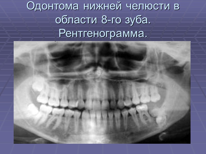 Амелобластома нижней челюсти. Рентгенограмма макропрепарата.