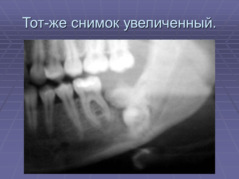 Амелобластома нижней челюсти. Рентгенограмма.