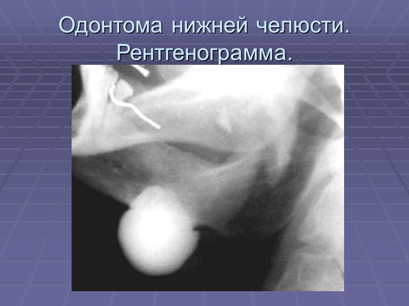 Амелобластома нижней челюсти. Рентгенограмма.