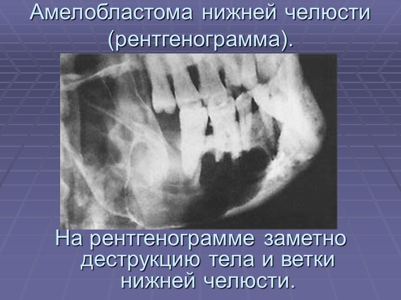 Внешний вид больной с амелобластомой нижней челюсти. Со стороны.