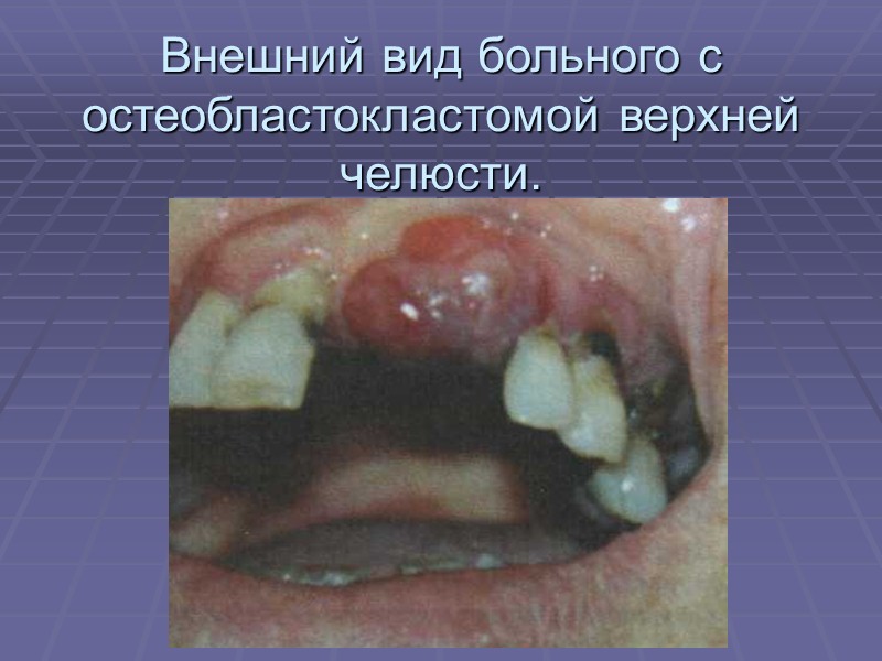 Остеобластокластома тела нижней челюсти слева. (До операции.)