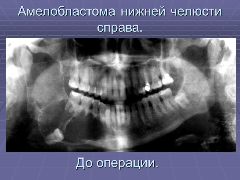 Амелобластома верхней челюсти в полости рта.