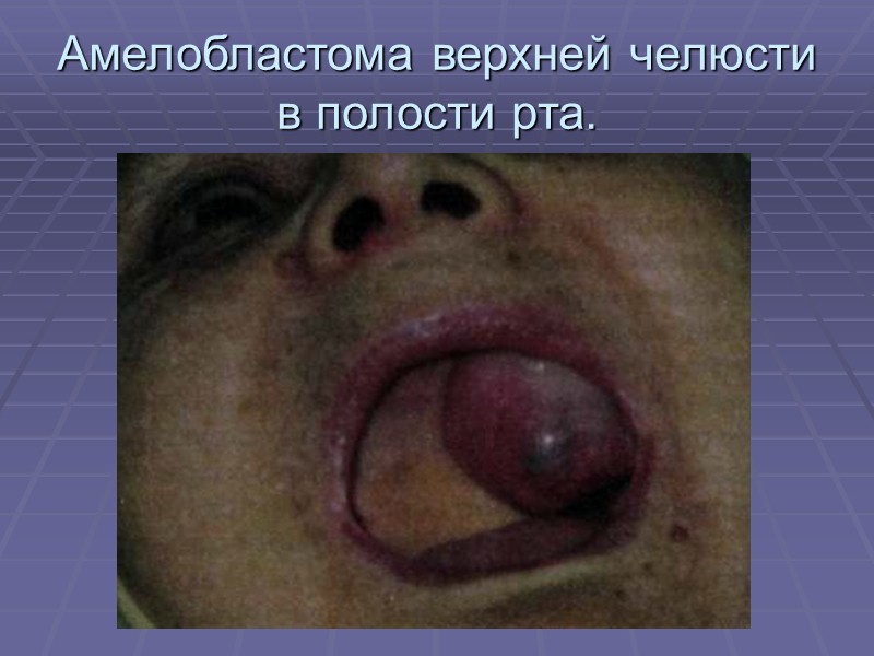 Гигантский эпулис. Вид в полости рта.