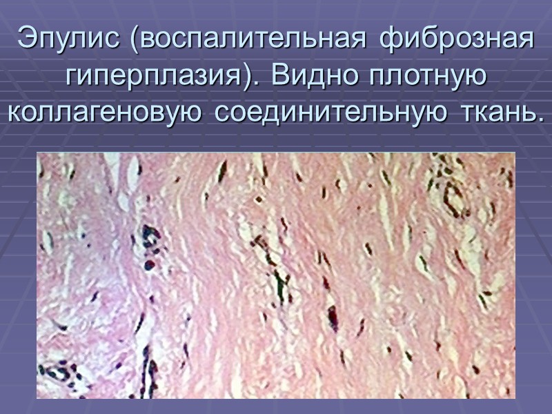 ангиоматозный эпулис челюсти