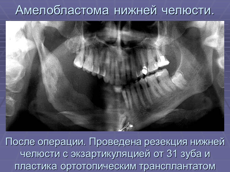 Амелобластома верхней челюсти в полости рта.