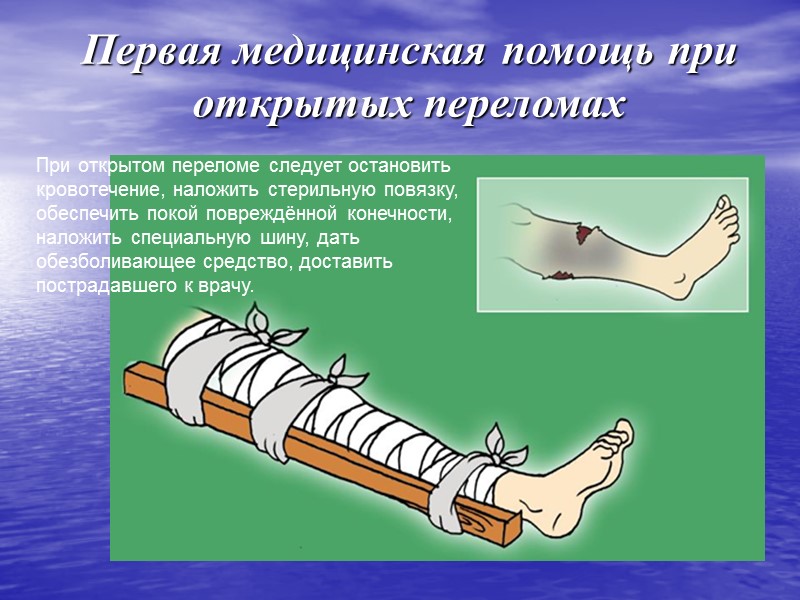 Первая помощь при открытом переломе картинки