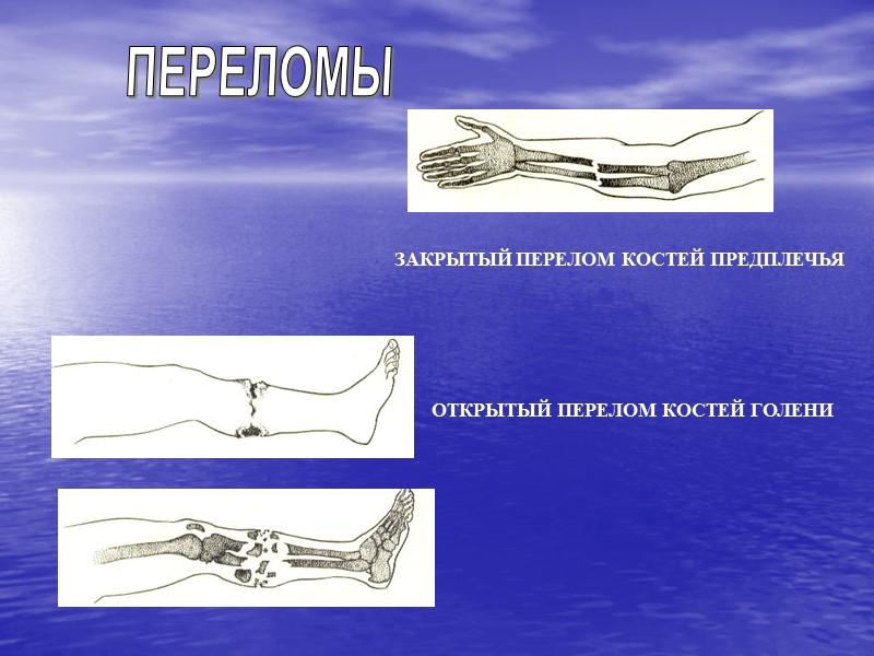 ПЕРВАЯ ПОМОЩЬ ПРИ ТЕПЛОВОМ (СОЛНЕЧНОМ) УДАРЕ  Тепловой удар - тяжелое патологическое состояние, обусловленное