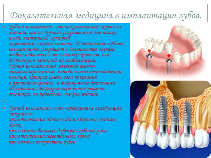Установка зубных имплантантов  Перед установкой зубных имплантантов, в первую очередь, будут устранены все