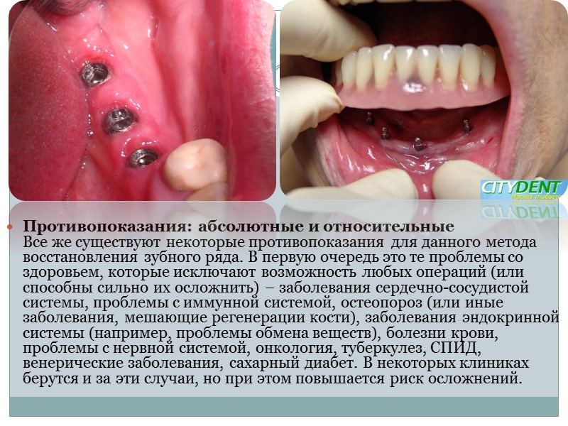 Различают «двухэтапную» и «одноэтапную» имплантации, а также имплантацию непосредственно после удаления зуба.  Двухэтапная