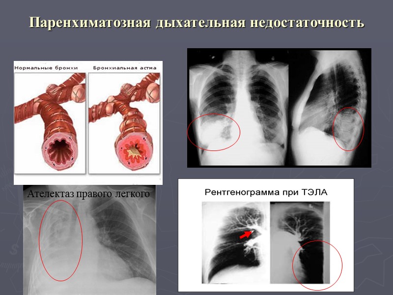 Недостаточность легких. Острая вентиляционная дыхательная недостаточность. Паренхиматозная дыхательная недостаточность. Патогенез паренхиматозной дыхательной недостаточности. Вентиляционная и паренхиматозная дыхательная недостаточность.