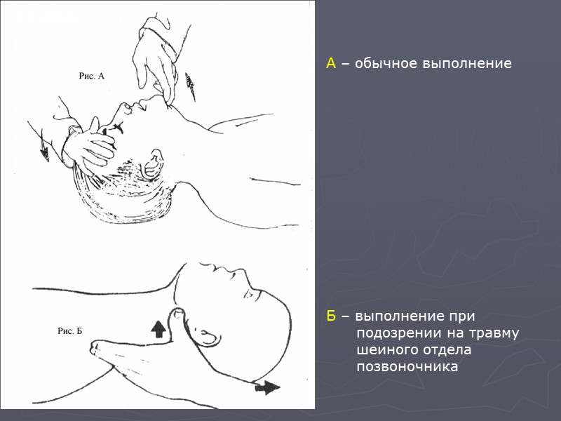 Защита дыхательных путей Игнорирование полноценного выполнения этих задач способствует прогрессированию гипоксии, неминуемо приводит к