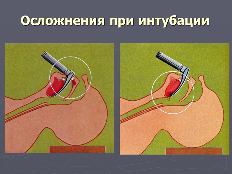 Возможные опасности и осложнения Слишком длинный воздуховод может вызвать полную обструкцию дыхательных путей (прижмёт