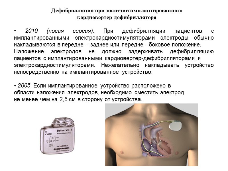 При наличии кардиостимулятора можно. Дефибрилляция наложение. Наложение электродов дефибрилляции электродов. Кардиовертер-дефибриллятор. Кардиостимулятор дефибриллятор.