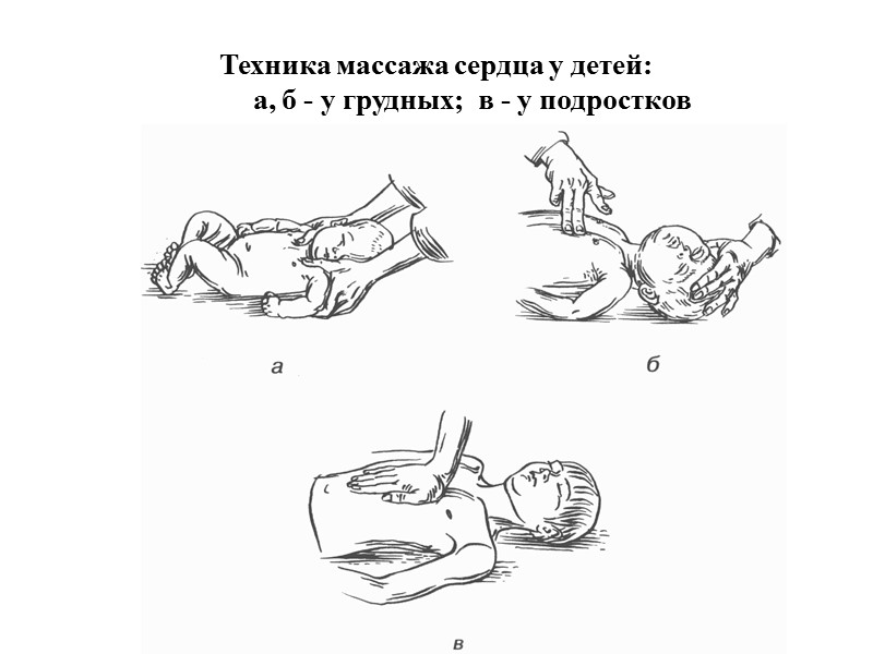 Ребенок в положении грудью и животом на передней поверхности предплечья спасателя, вниз головой, под