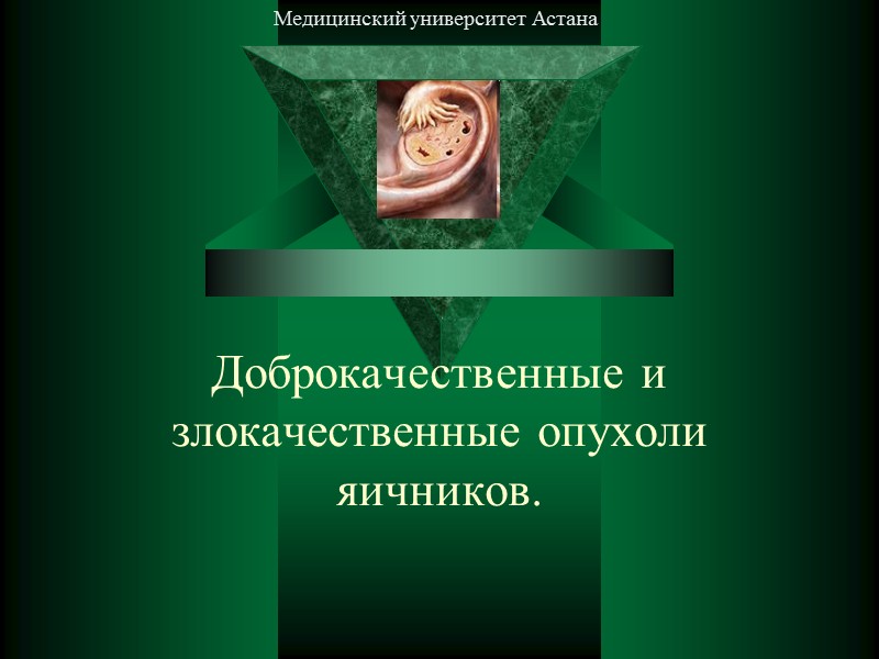 Доброкачественные и злокачественные опухоли яичников. Медицинский университет Астана