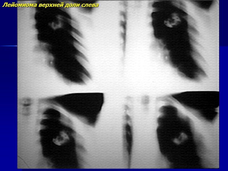 Артериовенозная мальформация верхней доли справа с сосудистой дорожкой к правой легочной артерии