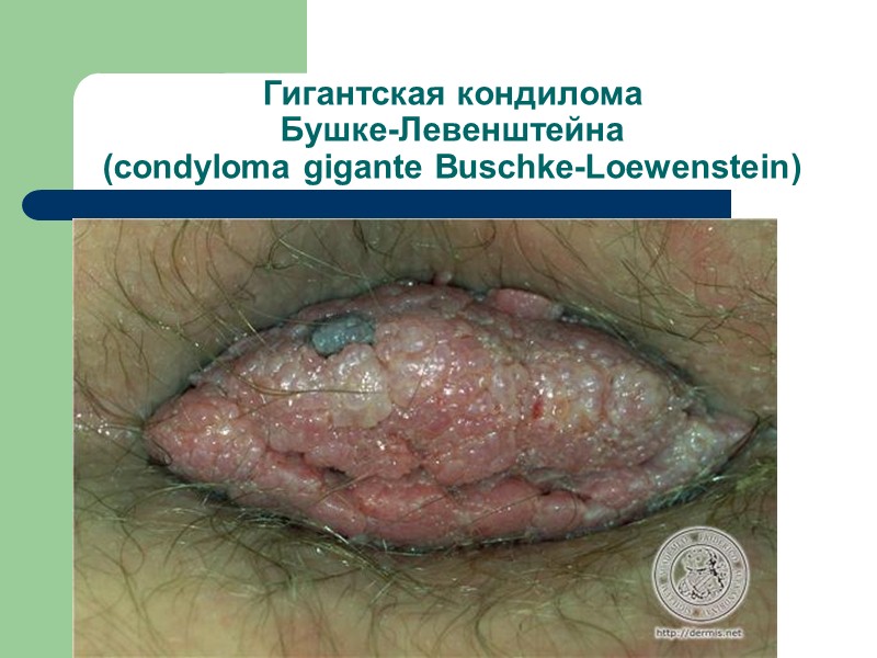Пигментная ксеродерма (xeroderma pigmentosum) – генетически детерминированное заболевание, проявляющееся высокой чувствительностью  к солнечному