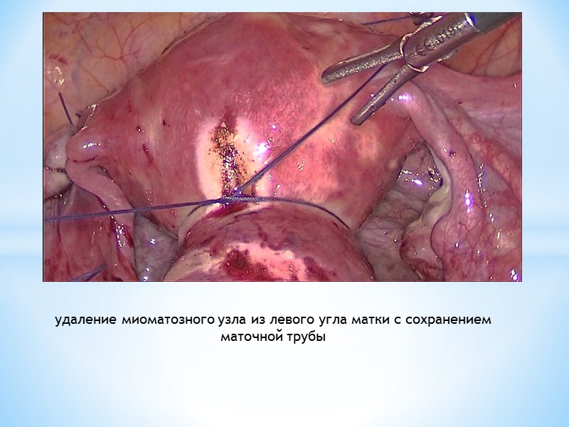 Гистероскопическая миомэктомия (гистерорезектоскопия) - удаление миоматозных узлов вагинальным доступом. Через влагалище и шейку в