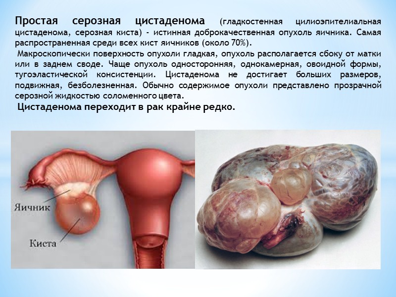 Классификация опухолей яичников.  I. Эпителиальные опухоли (цистаденомы): 1) серозные (цистаденома и папилярная цистаденома,