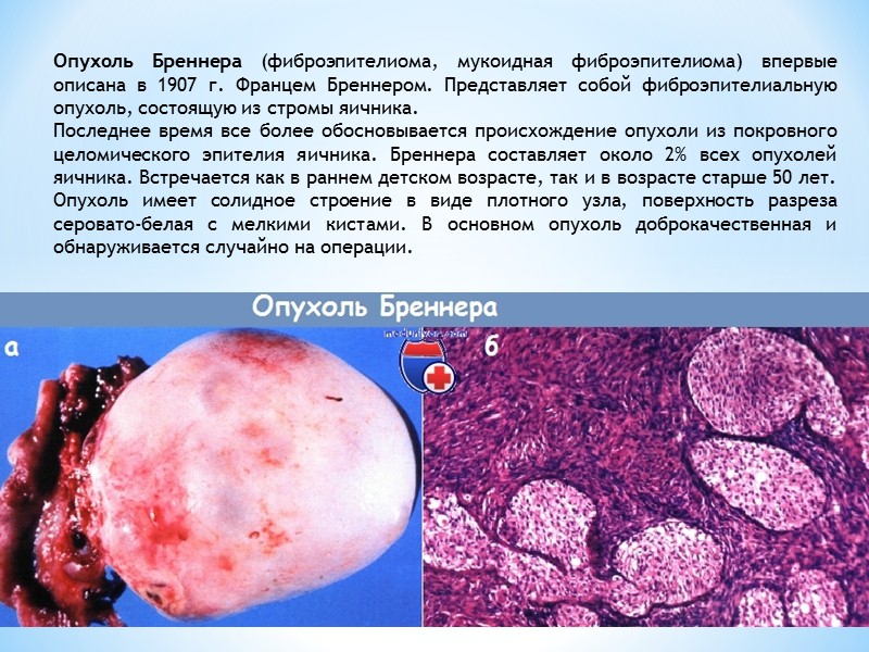 Серозная аденофиброма (цистаденофиброма) встречается относительно редко, часто односторонняя, округлой или овоидной формы, диаметром до