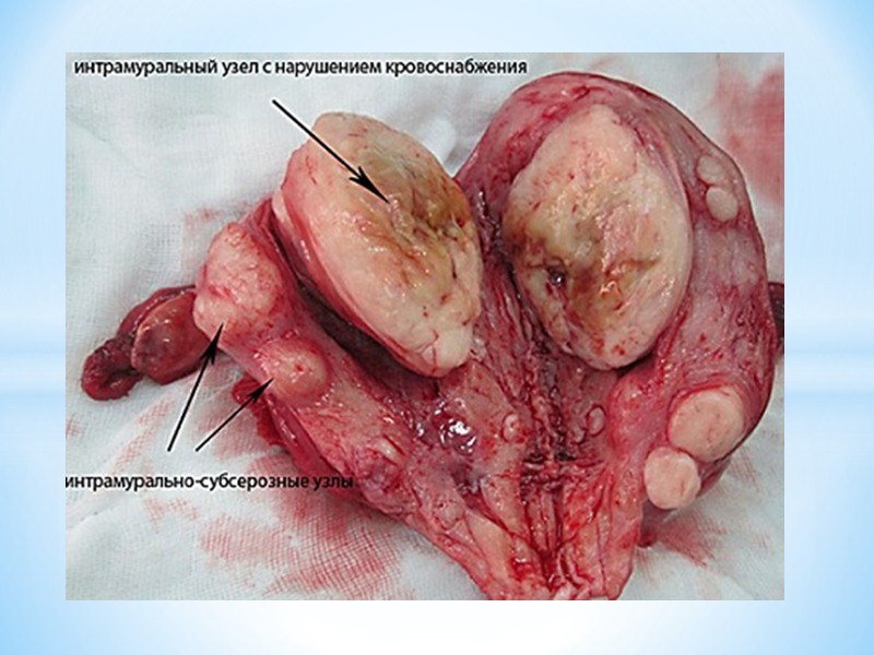 Гиперплазия эндометрия матки — это заболевание внутренней оболочки матки, при котором происходит изменение стромы