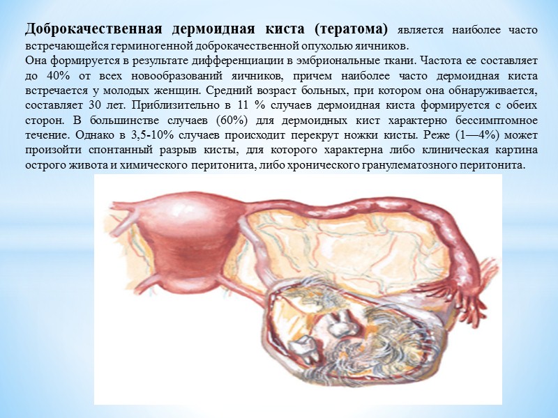 Эндометрио́з — распространённое гинекологическое заболевание, при котором клетки эндометрия (внутреннего слоя стенки матки) разрастаются