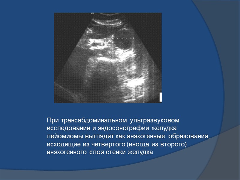 Обзорная рентгенограмма желудка в левой боковой проекции. На стенках желудка определяется несколько образований округлой