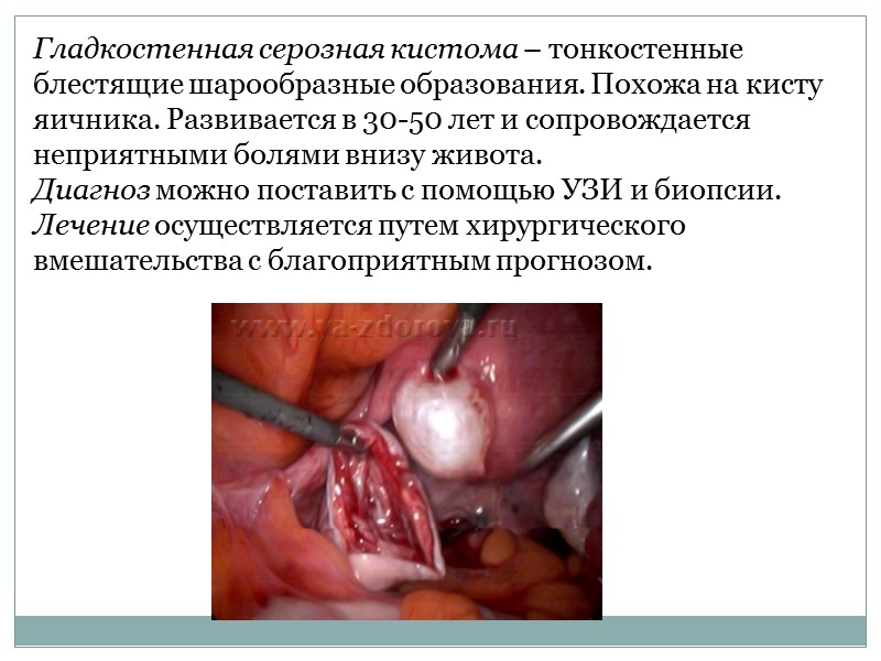 Муцинозные кистомы имеют блестящую поверхность и округлую форму. Величина ее может варьироваться в больших