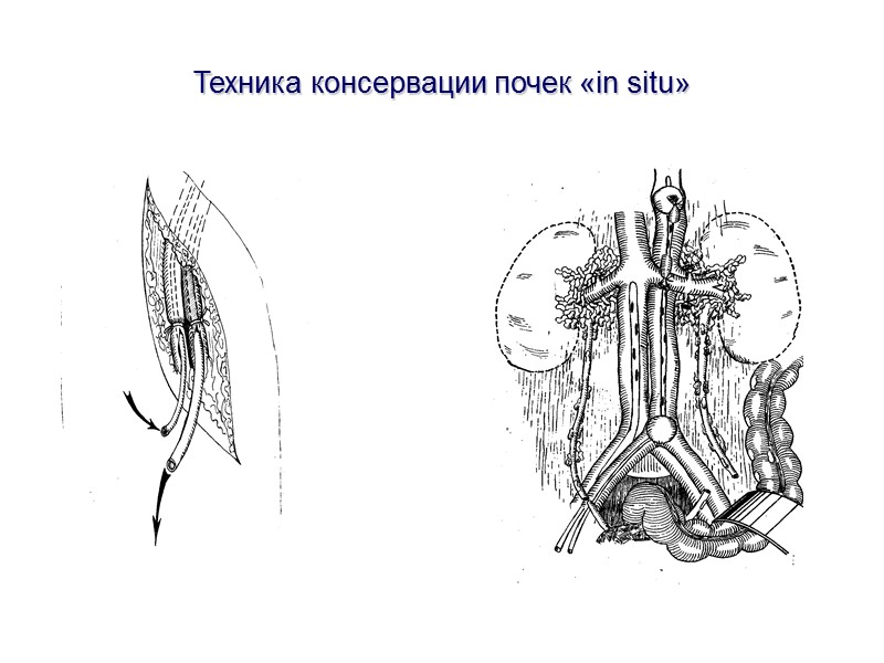 Критерии оценки потенциального донора Причина смерти мозга Возраст(18-60 лет) Вирусологический анамнез (ВИЧ, RW, HCV,