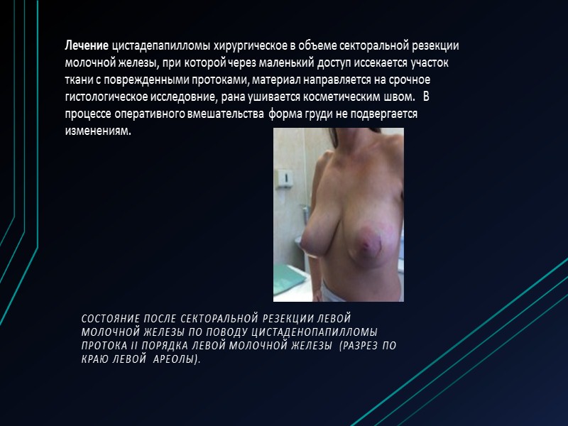 Филлоидная фиброаденома (листовидная, гигантская микросомальная фиброаденома) – предраковая  опухоль с бурным, активным ростом,