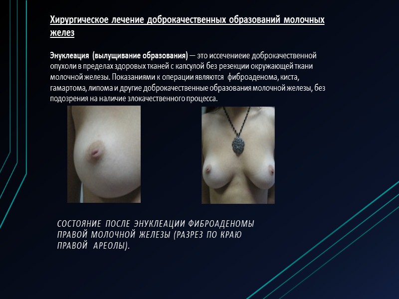 Киста молочной железы  представляет собой полость из концевых отделов протоков молочных желех, заполненную