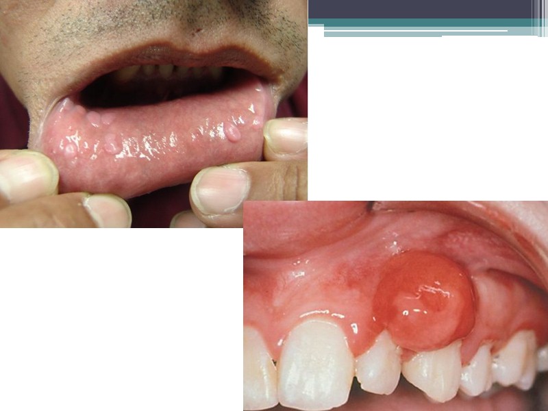 Фолликулярная киста Фолликулярная киста - развивается из фолликула зачатка зуба вследствие его аномалии. 