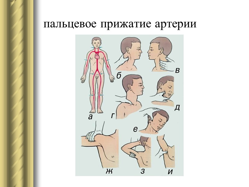 Пальцевое прижатие артерии в ране