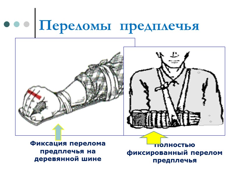 Перелом предплечья карта. Фиксация перелома предплечья. Шина на предплечье. Фиксация при переломе. Шина при переломе предплечья.