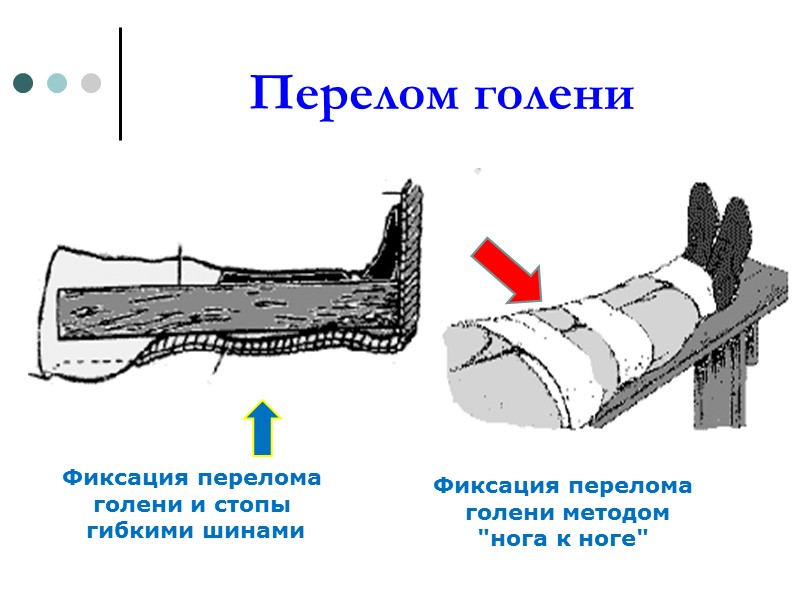 Кровотечение при открытом переломе голени