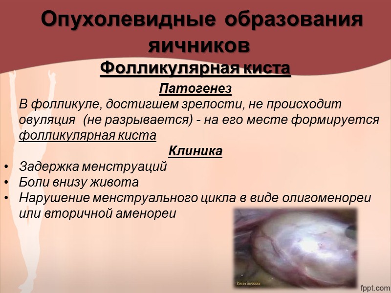Осложнения Некроз миоматозного узла Рождение миоматозного узла Малигнизация (саркома имеет вид рыбьего мяса)